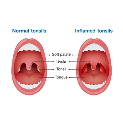 Tonsilitis .